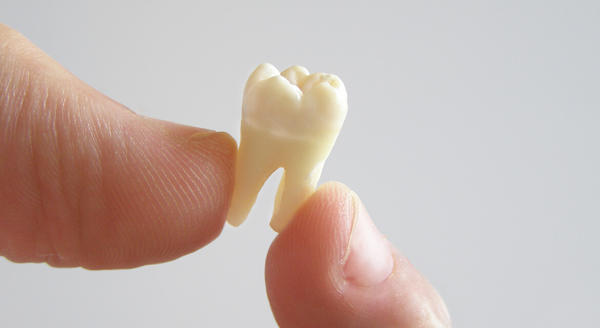 zubní implantáty
